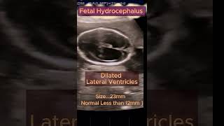 Fetal Hydrocephalus with Spine normal ultrasound pregnancy congenital hydrocephalus [upl. by Nniuqal409]