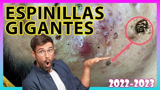 🔥 Estos GRANOS Y ESPINILLAS XXL van a EXPLOTAAAR⚠️ [upl. by Atcliffe]