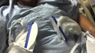 BREAST REDUCTION STEP 2 surgery and recovery [upl. by Anirehtac]