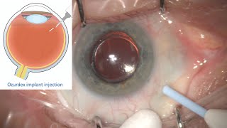 Ozurdex Implant Intravitreal Eye injection for Treatment of Retinal Oedema and Inflammation [upl. by Anyt]