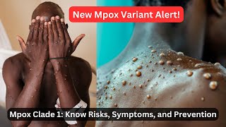 Mpox VARIANT ALERT What You Need to Know About Clade 1 Risks and Prevention [upl. by Dorree819]