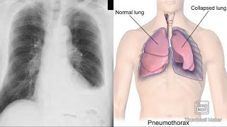 Pleurisy Pleural effusion Pneumothorax Hydropneumothorax Empyema Hemothorax clinicalAnatomy [upl. by Akemal]