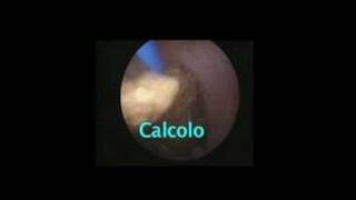 Ureteroscopy endoscopic treatment for ureteral stones [upl. by Alicea841]