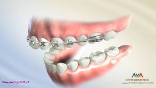 Orthodontic Treatment for Overjet Overbite  Wilson Bimetric Distalizing Arch Appliance [upl. by Pentheas]