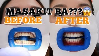 FIRST TEETH WHITENING EXPERIENCE SHOCKING RESULTS  Angel Dei [upl. by Marcoux]