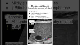 Choledocholithiasis stone in the common bile duct [upl. by Neerom223]