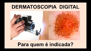 DERMATOSCOPIA DIGITAL  O que é este exame Para quem está indicado [upl. by Ridinger445]