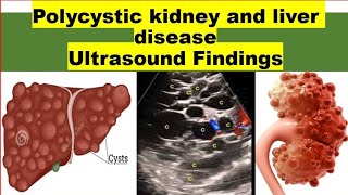 STOP Misdiagnosing Polycystic Kidney and Liver Disease with These Ultrasound Tips [upl. by Iharas681]