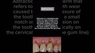 Abfraction  Dental Anomaly  Oral Biology  Dental School [upl. by Barrie]