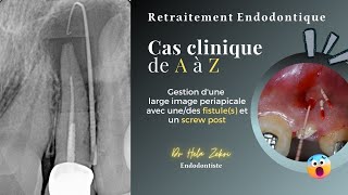 Retraitement endodontique Cas Clinique de A à Z fistule screw post obturation et controle [upl. by Sherl]