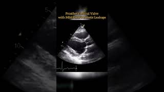 Prosthetic Mitral Valve echocardiogram echo Echocardiography For Beginners [upl. by Niels]