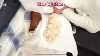 Big Cystic Acne Blackheads Extraction Blackheads amp Milia Whiteheads Removal Pimple Popping [upl. by Whitnell]