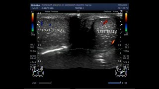 Ultrasound Video showing Testicular microlithiasis an uncommon case with Lt Inguinal Hernia [upl. by Cyprio]