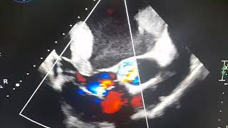 Thrombus in Transient  LAA Thrombus in Severe MS patient [upl. by Etteuqaj]