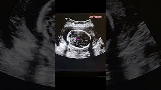 Fetal Biometry Series 1  Measuring the Biparietal Diameter pregnancy ultrasound [upl. by Enirehtakyram]