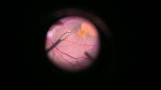 Vitrectomy with internal limiting membrane ILM peeling [upl. by Kahle]