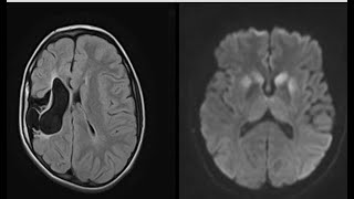 15 caseCNSradiologyneurobrainradiopediafrcrexamstipsamptricksCTMrixrayquestionsbestradi [upl. by Minette132]