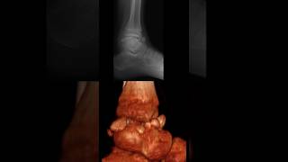 multiple intraarticular epiphyseal osteochondromas in the tibiotalar joint [upl. by Kavanaugh846]