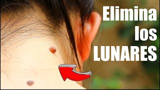 Cuándo y cómo ELIMINAR los LUNARES 🚫 Cuidado con los MELANOMAS Cáncer ❤️ DR ALBERTO CALVO QUIROZ [upl. by Elly]