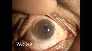 Therapeutic Keratoplasty Step by Step [upl. by Rexanna726]