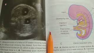 Chapter 11  Part 12  Alimentary System Clinicals  Embryology KLM  Simple  Quick  Easy [upl. by Zined820]