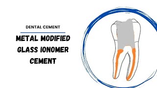 Metal Reinforced Glass Ionomer cement  Dental cermets [upl. by Duntson]