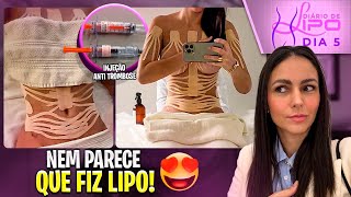 5 DIÁRIO DE LIPO MINHA RECUPERAÇÃO 😱😍  falando tudo [upl. by Leanor]