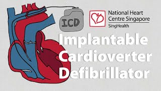 What is an Implantable CardioverterDefibrillator ICD  What to Expect [upl. by Shafer420]