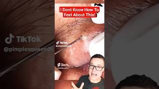 Perfect BLACKHEAD POPPING  What Do You Think shorts [upl. by Yorgerg]