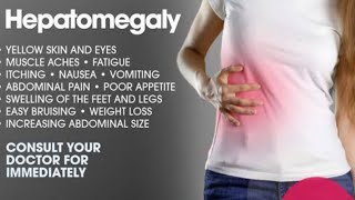 CASE Presentation  HEPATOMEGALY  Splenomegaly  Medicine [upl. by Thamora]