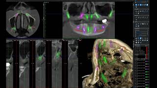 Treatment Planning Pterygoid Implants in Romexis 61 [upl. by Epner835]