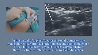 Ultrasound Guided Axillary Block Tutorial [upl. by Enaelem]