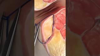 Laser Closure of Fistula Tract FiLaC Video credit SurgMedia Youtubecom [upl. by Lihp323]