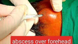 abscess over forehead  infected cyst over forehead  incision n drainage youtube dr doctor [upl. by Ardnuahsal]