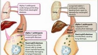 alpha 1 antitrypsin deficiency [upl. by Reeba]