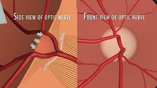 What are the nerve fibers as it relates to glaucoma [upl. by Bower]