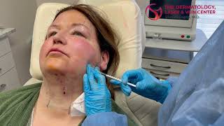 Masseter Botox Injections Reshape Your Jawline and Relieve Jaw Tension  Dr Shalini Gupta [upl. by Vanessa]