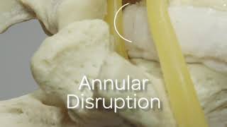 Extrusion and Protrusion Model of Disc Herniation [upl. by Korella]