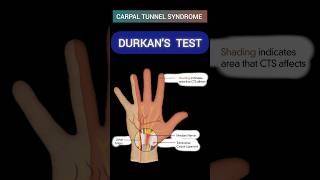 DURKANS TEST for Carpal Tunnel Syndrome🤚carpaltunnelsyndrome anatomy greysanatomy mbbs [upl. by Lleinad548]