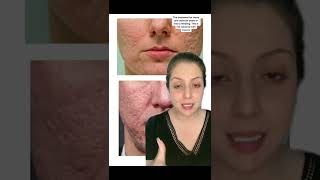 Treatment for pitted acne scars [upl. by Nivram]