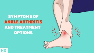 Dont Ignore Your Ankle Pain Understanding Ankle Arthritis [upl. by Pedrotti]