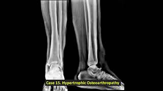 XRay Case 15  Hypertrophic Osteoarthropathy [upl. by Trainer]