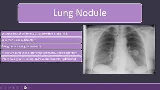 Chest Xray with Lung Nodules and Bronchiectasis radiology [upl. by Irual]