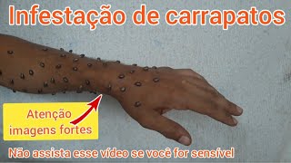 Infestação de carrapatos  não assista esse vídeo se você for sensível [upl. by Schnurr]