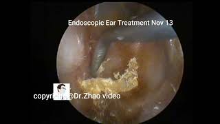 Ear wax removalPostoperative review of cholesteatoma [upl. by Aehsal]