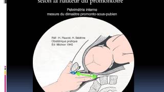 GYNECOLOGIE Examen du bassin obstetrical [upl. by Akeenahs998]