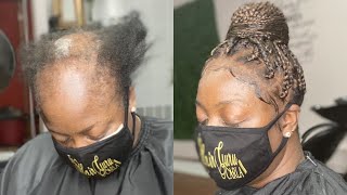 BOX BRAIDS ON SEVERE ALOPECIA CLIENT  TOP BUNKNOT [upl. by Nivrag]