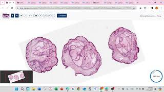 Basel cell carcinoma and pinkus variant [upl. by Nnayelhsa]