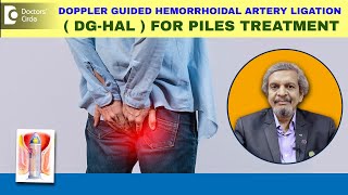 Treat piles fast with Doppler Guided Hemorrhoidal Artery LigationDrRajasekar M R Doctors Circle [upl. by Ethan]