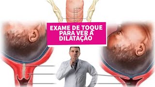 Exame de Toque para ver Dilatação e Apagamento do Colo do Útero [upl. by Novanod]